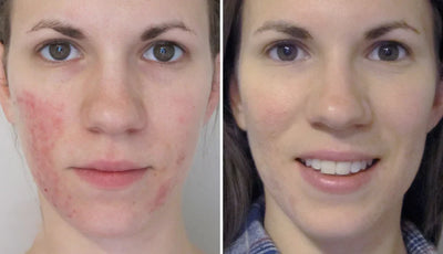 Rosyra Sérum Anti-Rougeurs