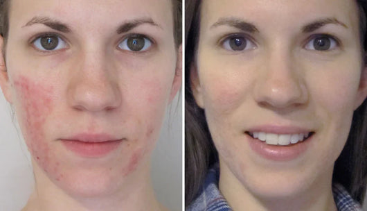 Rosyra Sérum Anti-Rougeurs