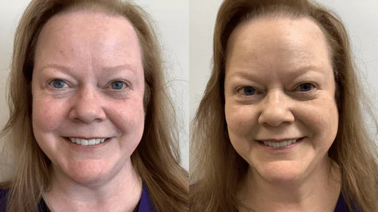 Rosyra Sérum Anti-Rougeurs